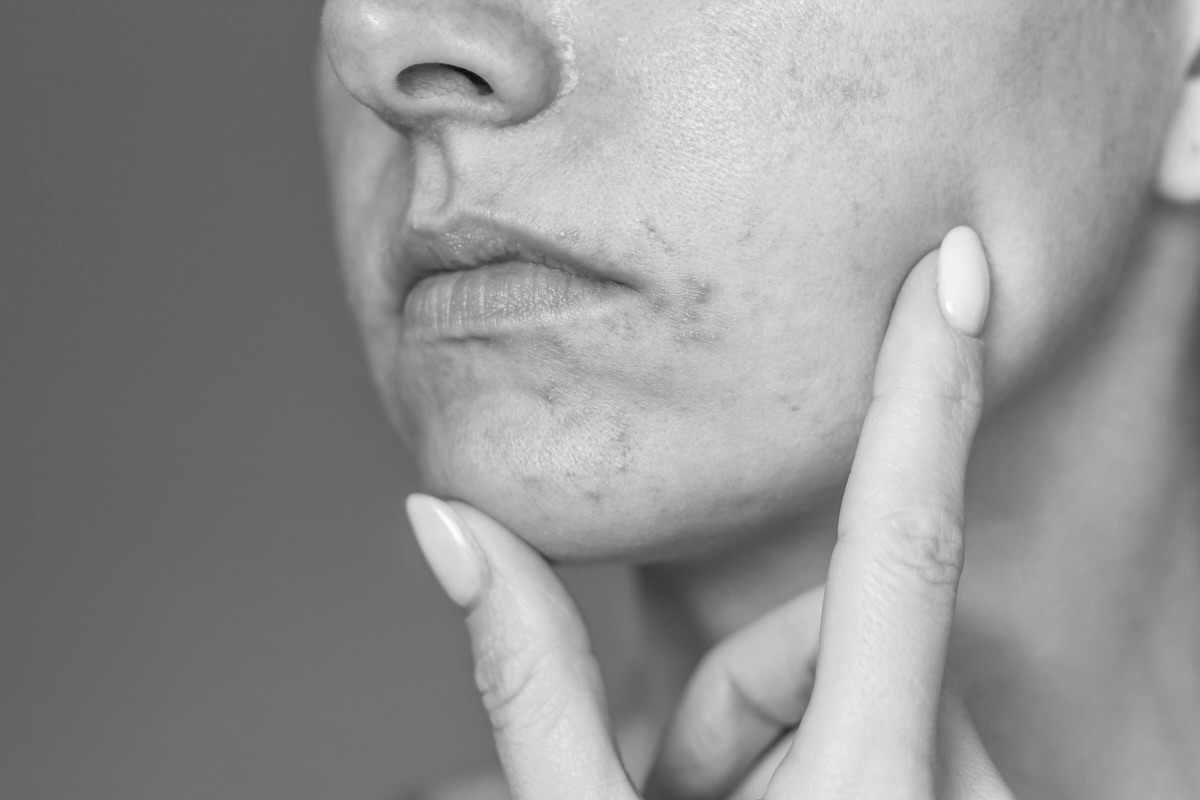 Inflammatory skin disorders - Acne, Perioral Dermatitis and Rosacea